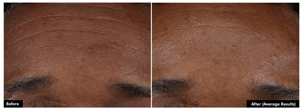 SkinCeuticals P-TIOX — Needle-Free Anti-Wrinkle Serum
